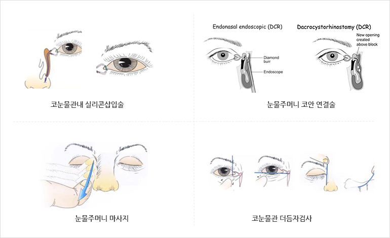코눈물관내 실리콘삽입술/눈물주머니 코안연결술/눈물주머니마사지/코눈물관더듬자검사